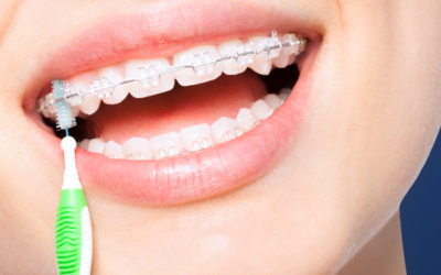 How to Clean Your Teeth with Braces: A Simple Guide