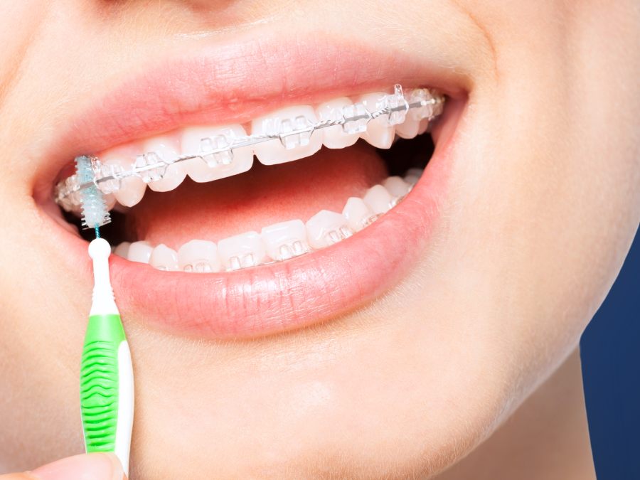 How to Clean Your Teeth with Braces: A Simple Guide